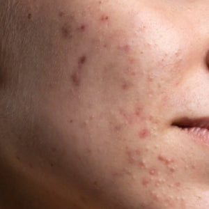 Pigmentation