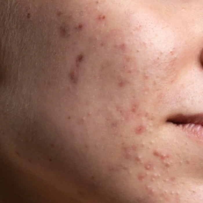 Pigmentation